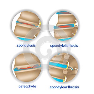 Spine diseases. Various pathologies of intervertebral discs and bones. photo